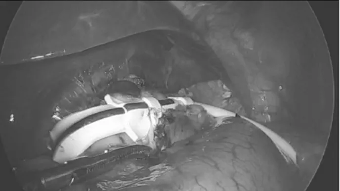 Fig.  1.  Diagnostic  laparoscopy  showing  unbuckled  MIDBAND TM .