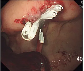 Fig.  1.  A  round  ulcerative  lesion  with  adherent  clot  and  oozing. Fig.  2.  Endoscopic  hemostasis  using  hemoclips.