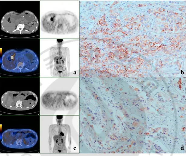 Fig. 1. Representative PET and immunohistochemical staining images for GSRC with  GLUT-1  expression  on  membranes  and  cytoplasms