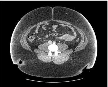 Fig.  3.  The  position  of  the  ports  :  the  first  trocar  was  inserted  with zero  degree  laparoscope