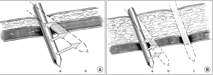 Fig.  4.  (A)  Laparoscopic  trocar  insertion  in  non-obese  patient  a.  The  operator  could  shift  the  position  of  trocar  tip  b  with  either  pushing  or  pulling  the  handle  of  trocars
