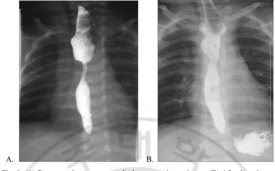 Fig. 1. (A) Postoperative contrast study demonstrating stricture. (B) After bougienage, the  stricture was improved