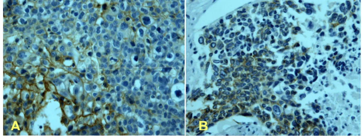 Fig. 3. Classification of immunohistochemical stains according to the location of  E-cadherin  expression  in  hypopharyngeal  SCC  tissue