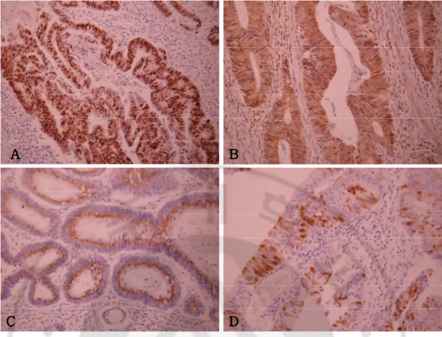 Fig.  1.  Histochemical  staining  for  p53,  bcl-2,  survivin  and  cleaved  caspase-3