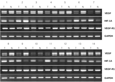 Fig.  1.  VRGF,  VEGFα α α αR-1,  HIF-1α  mRNA  expression  in  papillary  thyroid  micro  carcinoma  and  adjacent  normal  tissues