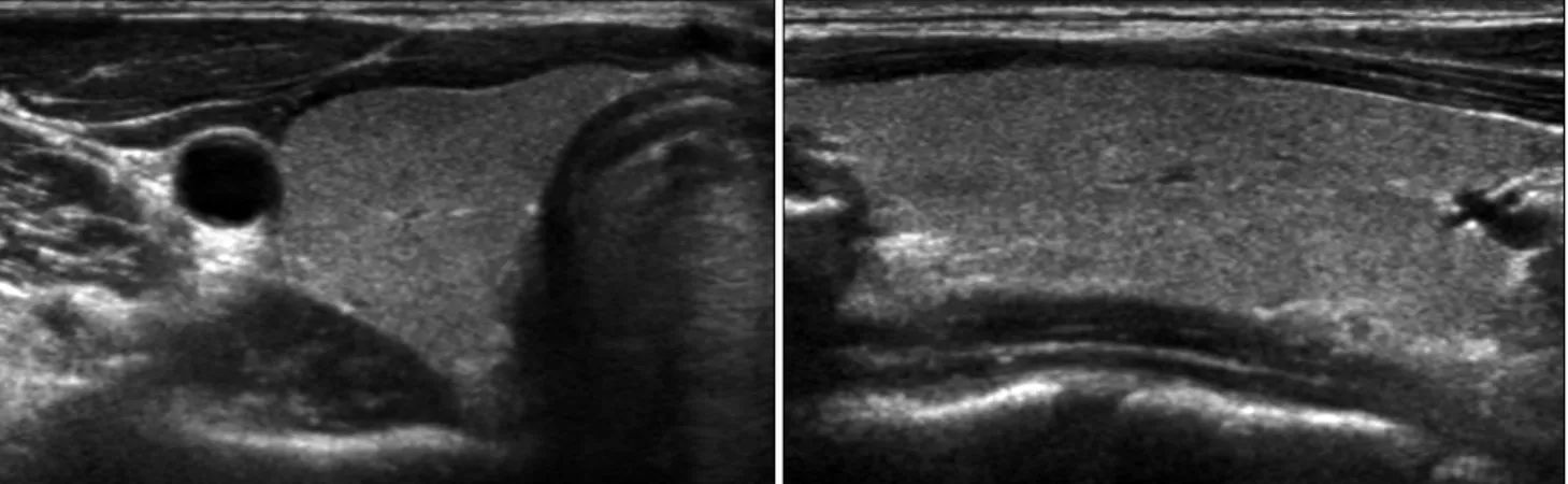 Fig. 1. Ultrasound findings of normal thyroid gland.  정하며 길이는 세로스캔에서 측정한다. 갑상선엽의 너비는 기도 모서리를 통과하는 가상의 수직선으로부터 갑상선 가장 외측까지의 최대 거리를 측정한다