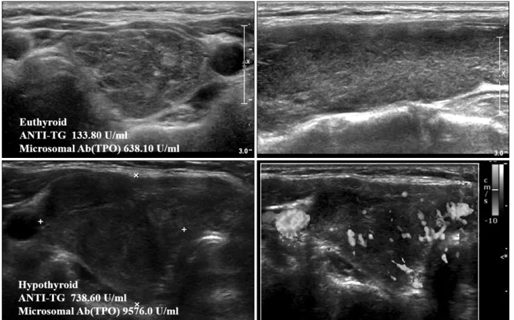 Fig. 2. Hypoechogenicity of the thyroid in Hashimoto’s thyroiditis. 조직학적 변화에 따라 다양하게 나타나며, 갑상선 여포의 파괴, 림프구 침윤 및 염증의 만성화 정도와 침범 범위에 따라 달라진다