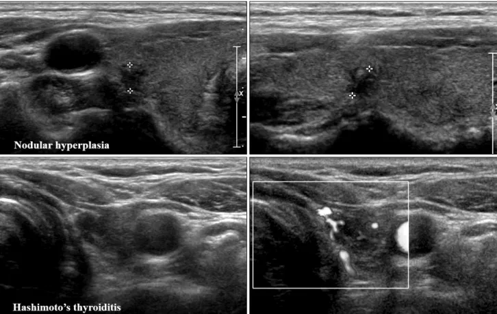 Fig. 3. False-positive ultrasound features within Hashimoto’s thyroiditis.도플러 검사에서 주변부 또는 불규칙한 혈류 소견, 미세석회화, 낭성 변화 등이 있다.(16) 하시모토 갑상선염은 갑상선 림프종의 위험인자로 알려져 있다.(17) 갑상선 림프종은 초음파 검사에서 하시모토 갑상선염 내에 경계가 불분명하며 현저한 저에코의 고형 결절로 관찰된다