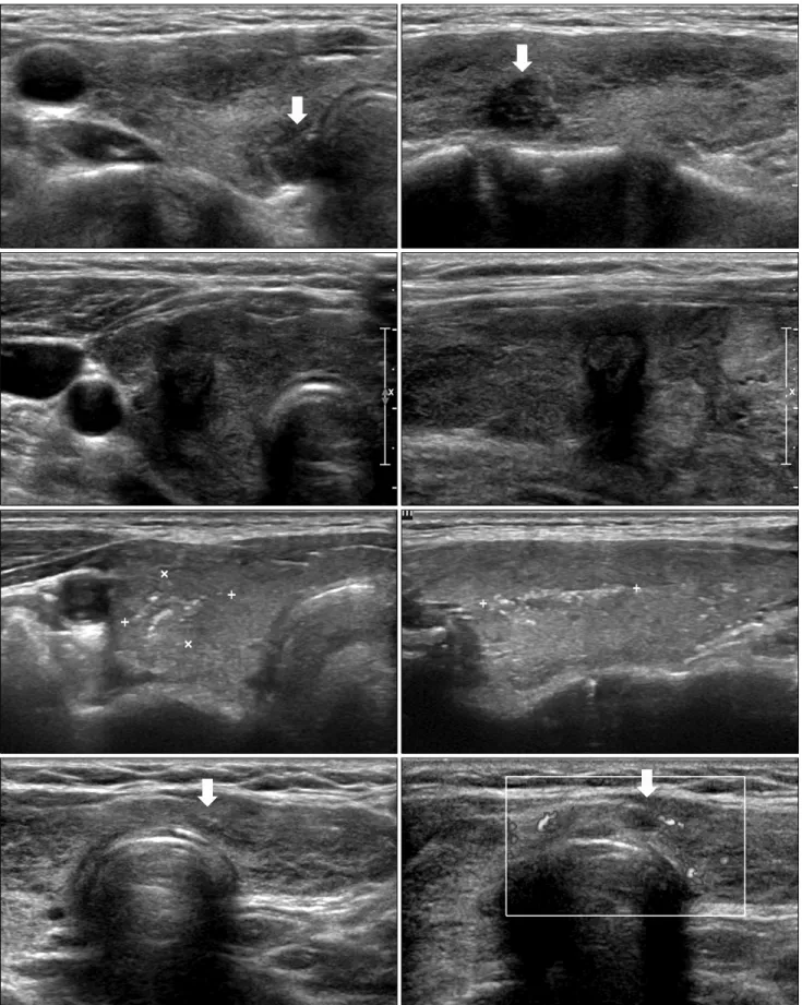 Fig. 4. Papillary carcinoma within Hashimoto’s thyroiditis. 