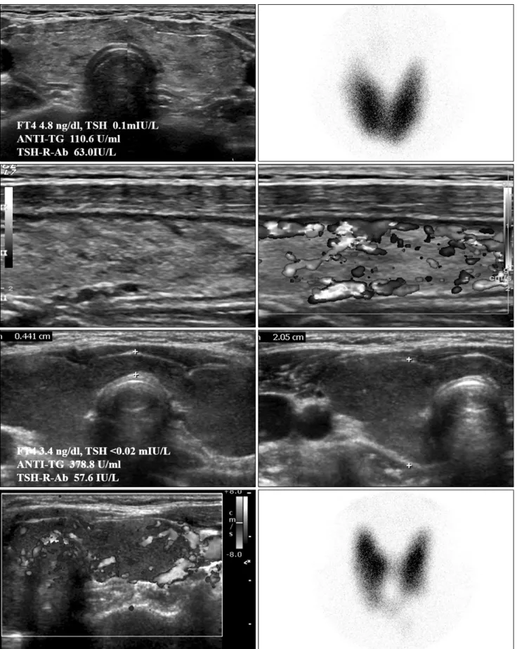 Fig. 5. Graves’ disease and thyroid inferno in ultrasound.