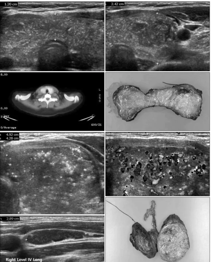 Fig. 6. Diffuse sclerosing variant papillary carcinoma with Hashimoto’s thyroiditis.