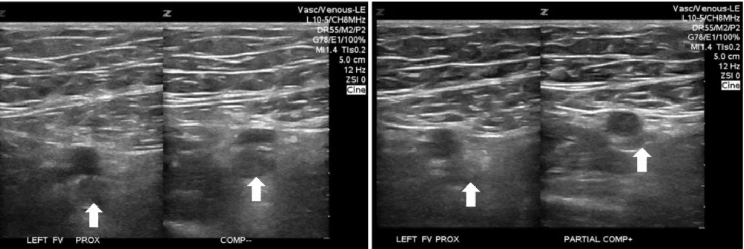Fig. 2. Acute deep vein thrombosis (left) and chronic deep vein thrombosis (right).