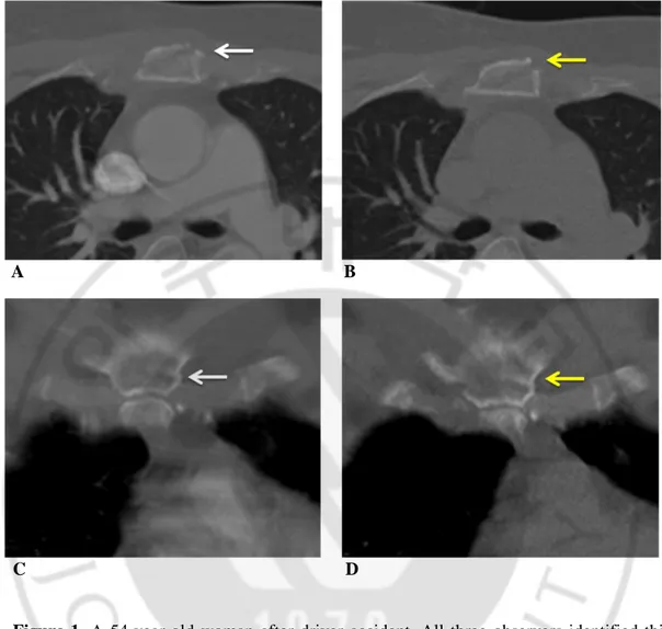 Figure 1.  A  54-year-old  woman  after  driver  accident.  All  three  observers  identified  this 