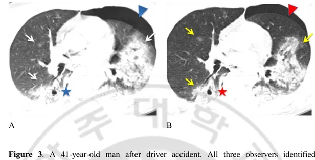 Figure  3.  A  41-year-old  man  after  driver  accident.  All  three  observers  identified 