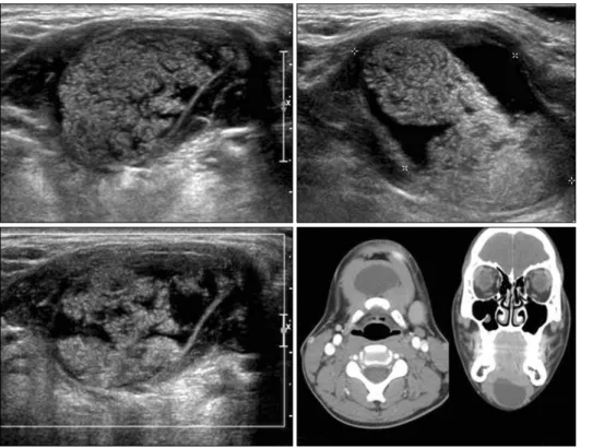 Fig. 3. 15-year-old man with dermoid  cyst.견을 보이는 경향이 있으나 고형 종괴와 달리 후방음향증강이 관찰된다.(12) 유피낭종 속의 내용물은 상층은 삼출액과 비슷하지만 하층은 치즈 같은 케라틴 물질로 차있기 때문에 초음파검사로 세밀하게 관찰하면 진단이 가능하다(Fig