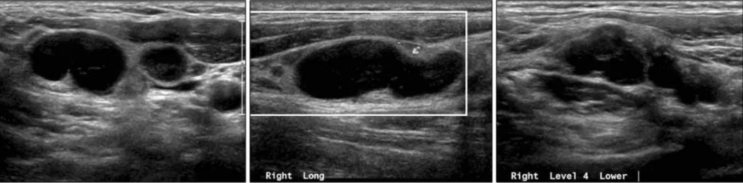 Fig. 9. 23-year-old woman with Hodgkin lymphoma. 다.(28)  요    약 경부 종괴는 모든 연령에서 다양한 원인에 의해 발생하 는 흔히 접할 수 있는 소견으로, 원인에 따라 선천성 또는  발달성, 염증성, 신생물에 의한 종괴로 구분할 수 있다