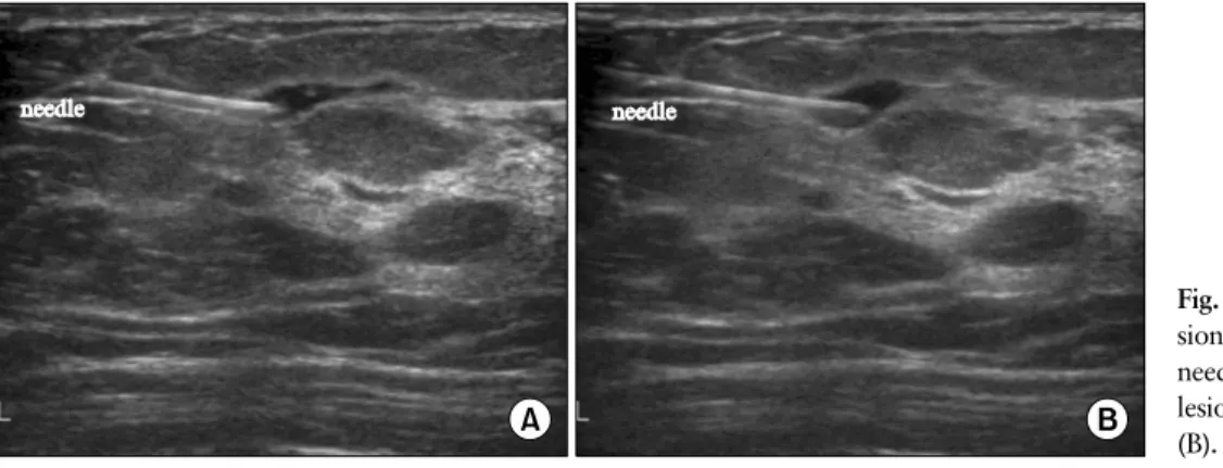 Fig. 1. Ultrasound-guided intrale- intrale-sional triamcinolone injection. A  needle tip was inserted into the IGM  lesion before (A) and during injection  (B).