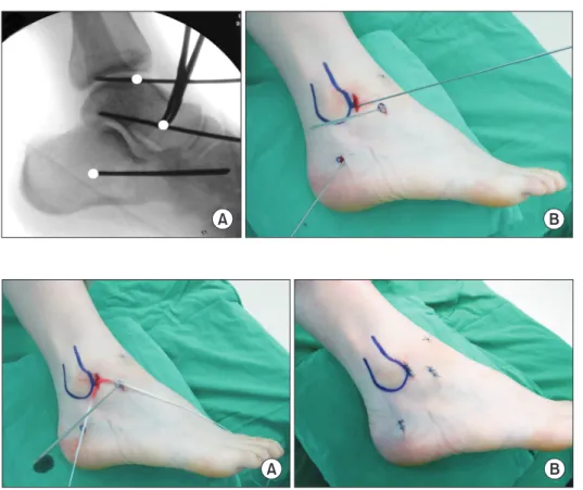 Figure 1. Intraoperative fluoroscopic image  (A) and photograph (B) show the entry points  of the suture-tape.