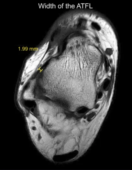 Figure 4. Measurement of width of the anterior talofibular ligament (ATFL)  on T1-weighted axial magnetic resonance imaging.