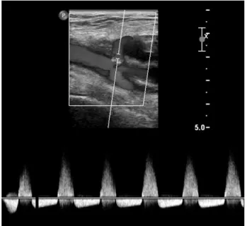 Fig. 2. Spectral Doppler waveform of pseudoaneurysm. The ‘to and  fro’ pattern is the pathognomonic sign.