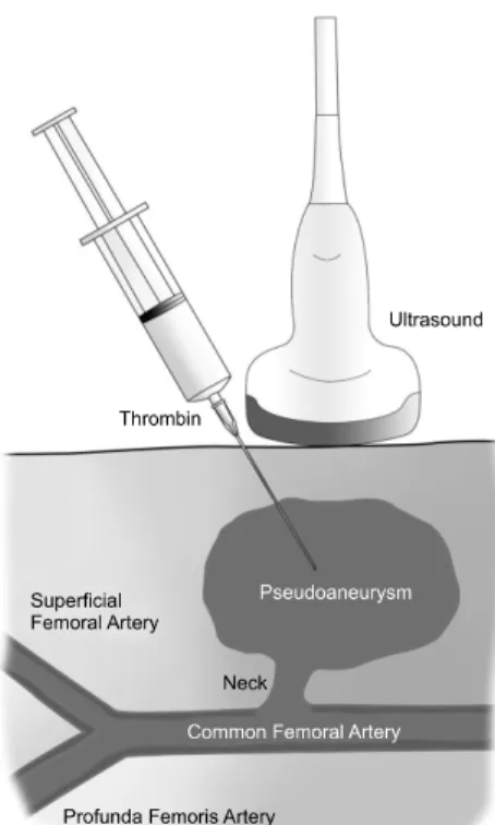 Fig. 3. Schematic diagram illustrating the ultrasound guided thrombin  injection. 수 있고 수술적 치료를 위하여 추가적인 마취가 필요하며 지속적인 항응고제 치료가 필요한 환자의 경우 수술 후 항응고제 사용에 제한을 받을 수 있다.(16,17) 이전에는 수술적 치료가 표준 치료법이었으나 이러한 이유 때문에 1991년도에 초음파를 이용한 압박법이 성공적으로 보고된 후에는 비수술적 방법을 이용한 