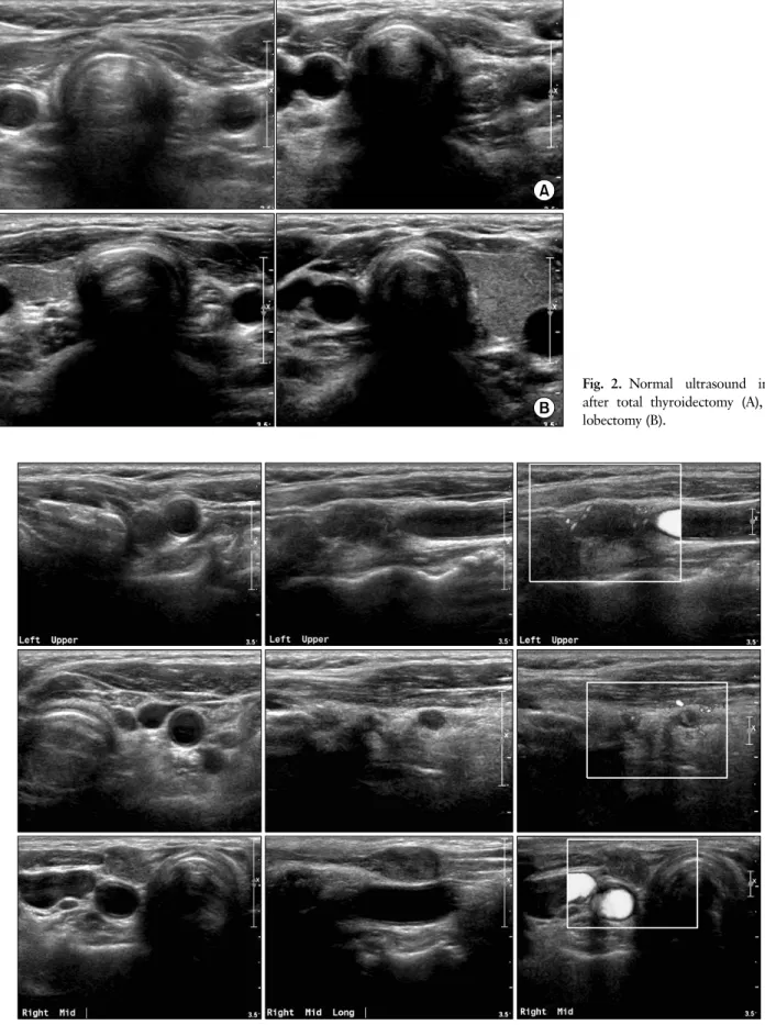 Fig. 2. Normal ultrasound image  after total thyroidectomy (A), and  lobectomy (B).