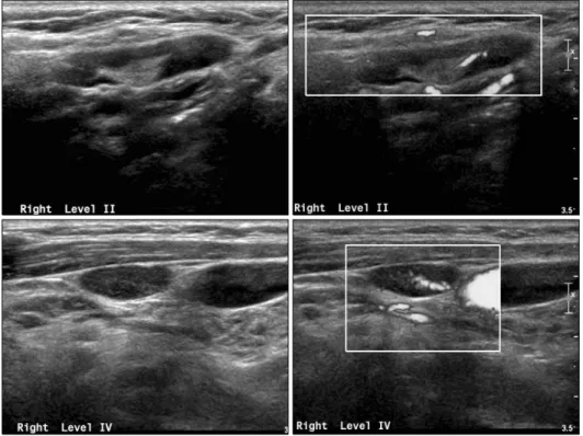 Fig. 5. Ultrasound image of normal  or benign node in lateral neck.