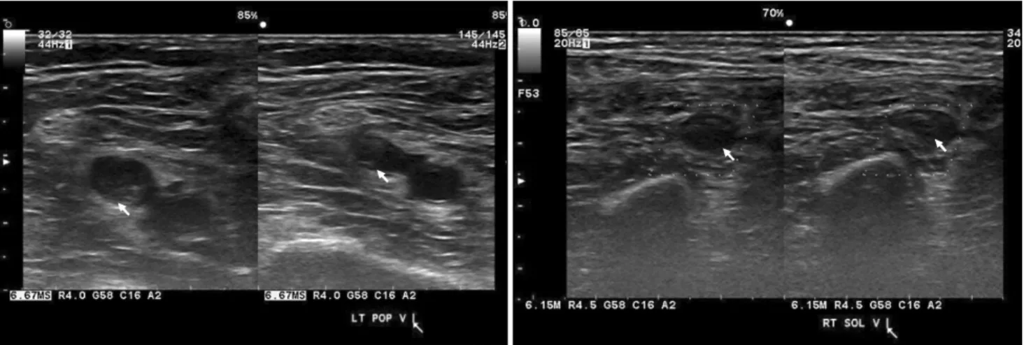 Fig. 1. Popliteal deep vein thrombosis (left), soleus muscle vein deep vein thrombosis (right).서    론심부정맥혈전증의 일반적 발생률은 약 1,000명 중 1명으로 나타나며 수술이나 암등의 위험인자가 생길수록 발생률은 더욱 증가한다.(1,2) 또한 폐색전증 및 혈전 색전증 등으로 인한 사망률 및 이환율이 높아질 수 있다.(3) 이러한 심부정맥혈전증을 진단하기 위한 다양한 방법이 