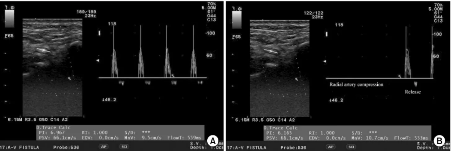 Fig. 1. Dynamic Allen’s test using duplex ultrasound of the first digit with manual compression of the radial artery