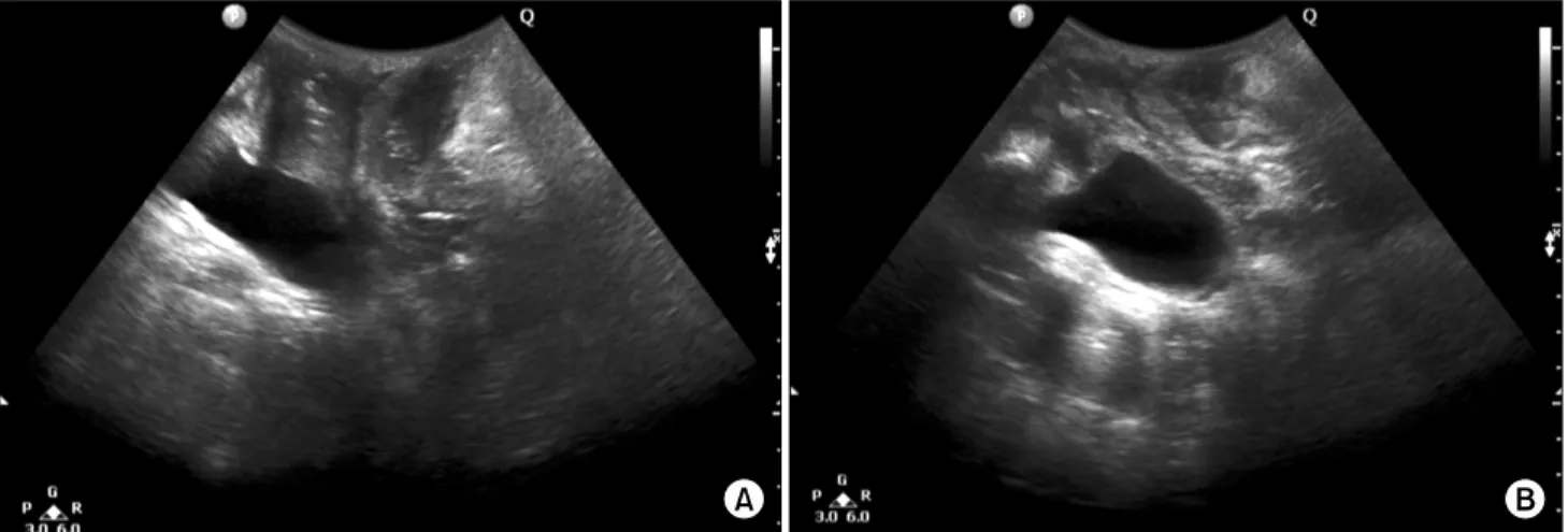 Fig. 5. Movement of anorectum, at rest&amp; during straining . (A) At rest, (B) During straining.