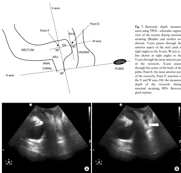 Fig. 7. Rectocele depth measure- measure-ment using TPUS : schematic sagittal  view of the rectum during maximal  straining (Bladder and urethra not  shown)
