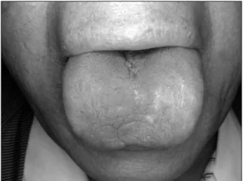 Fig.  2.  Xerostomia  and  fissured  tongue  in  the  dorsal  surface  of  the  tongue.