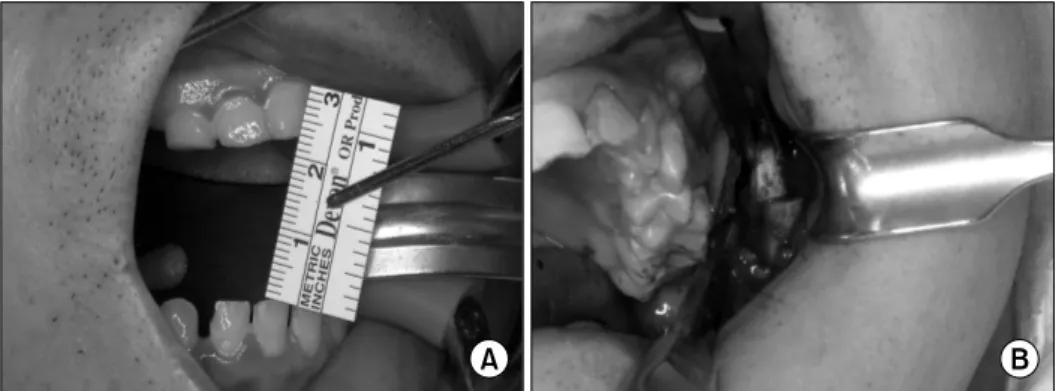 Fig.  4.  (A)  Mouth  opening  limitation after  radiation  therapy,  (B)   coronoi-dectomy  for  mouth  opening
