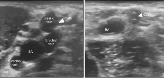 Fig. 4. Compressibility of the ca- ca-theterized vessel, a simple and reliable  method for determining catheter-  related thrombosis