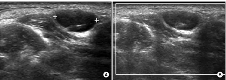 Fig. 5. 18 G core needle biopsy were performed on the lymph node.