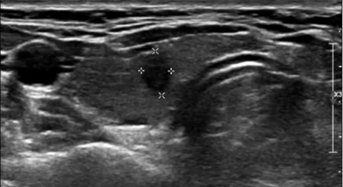 Fig. 2. Right papillary carcinoma in a 35-year-old man. Sagittal  gray-scale ultrasonographic image shows microcalcifications in a 1.4 