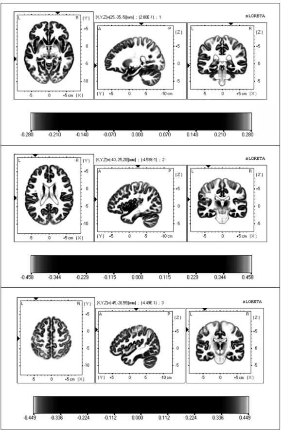 Fig. 2. Brain Imaging of maximum difference of brain activation between pre and post acupuncture treatment