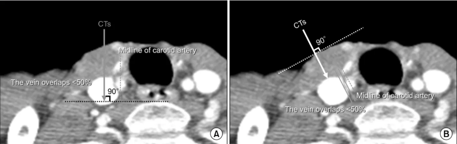 Fig. 4. CT images. The CT images were obtained by connecting a hypothetical line passing through the middle of the internal jugular vein to the vertical axis at ground (CTg, A) and the perpendicular axis to the skin (CTs, B), respectively.