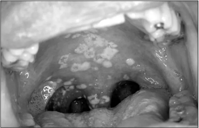 Table  1.  Risk  factors  of  oral  candidiasis 19 . Local  Factors  (Mucosal  Barrier  Function)     Heavy  smoking