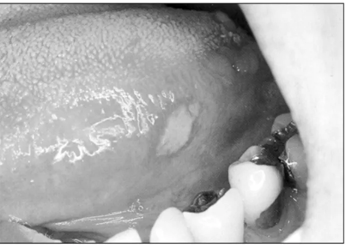 Fig.  3.  Recurrent  Aphthous  Stomatitis.