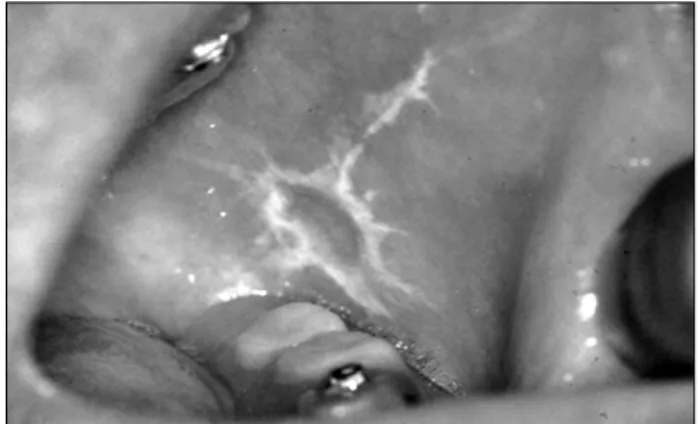 Fig.  5.  Chemoradiotherapy  induced  mucositis.