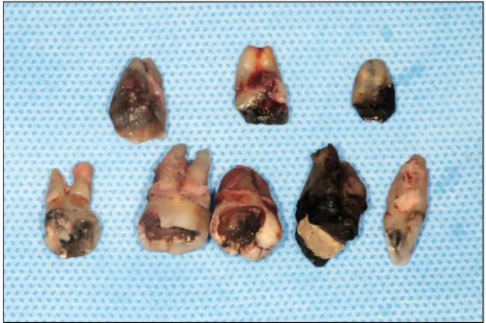 Fig.  1.  Extracted  teeth  due  to  dental  caries.