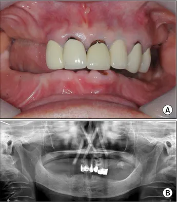 Fig.  2.  (A)  Intraoral  photo  of  patient  with  chronic  periodontitis.
