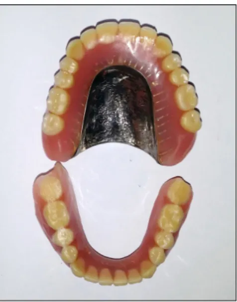 Fig.  4.  Complete  denture  for  fully  edentulous  patient.