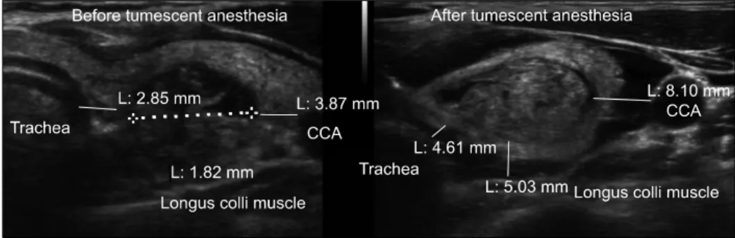 Fig. 1. The distances between no- no-dule and major structures were  measured on PACS image before and  after tumescent anesthesia using same  method