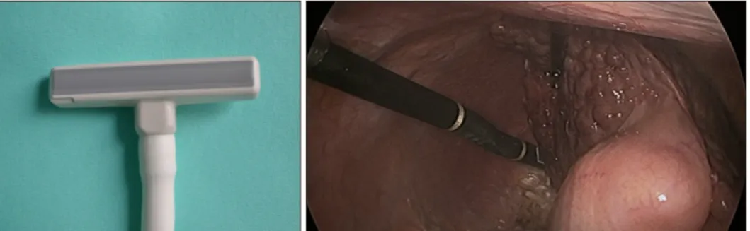 Fig. 3. Intraoperative linear probe  and laparoscopic flexible probe.