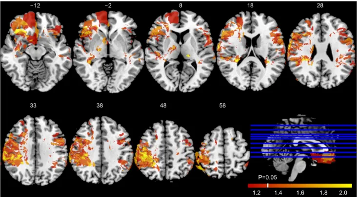 Fig.  2.  Correlation  between  lesion  images  and  FDS  oral  score.  The  result  of  VLSM  shows  positive  correlation  between  damaged  brain  lesions  and  FDS  oral  score