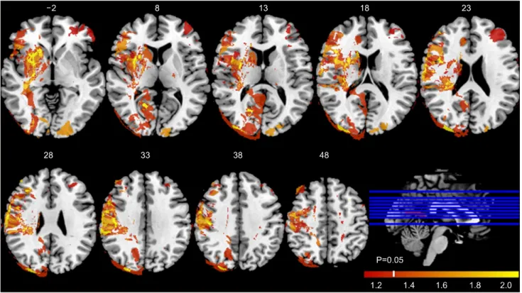 Fig.  3.  Correlation  between  lesion  images  and  FDS  pharyngeal  score.  The  result  of  VLSM  shows  positive  correlation  between  damaged  brain  lesions  and  FDS  pharyngeal  score