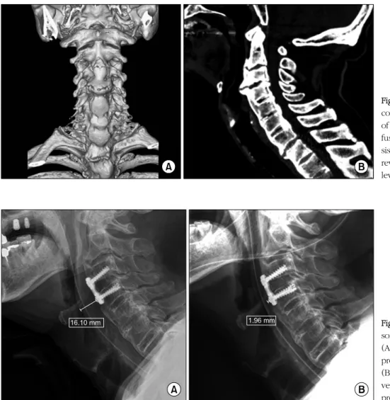 Fig.  2.  (A)  Three-dimensional  re- re-construction  computed  tomography  of  the  cervical  spine  revealed   dif-fuse  idiopathic  skeletal   hyperosto-sis  (DISH)