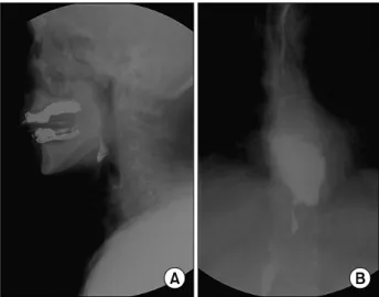 Fig.  1.  The  initial  videofluoroscopic  study  (VFSS)  with  barium.